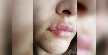 Жительнице Башкортостана искалечили губы во время процедуры татуажа
