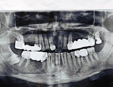 В челюсти у жителя Башкирии обнаружили опухоль размером 3х3 сантиметра