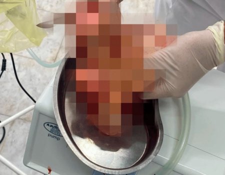 В Уфе врачи удалили у молодой девушки гигантскую опухоль матки