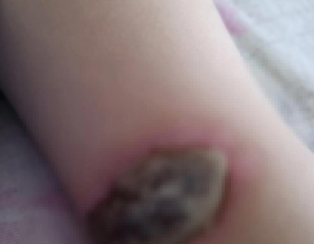 «Ожог до мяса»: в Башкортостане трехлетний ребенок пострадал в детском саду
