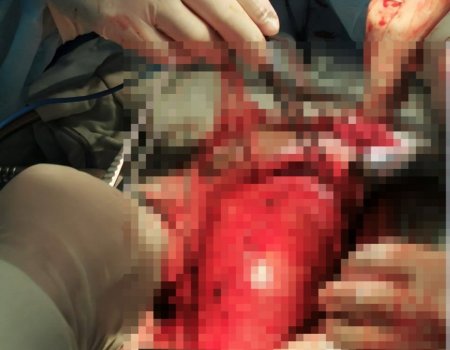 В Уфе врачи удалили у пациента «бомбу замедленного действия» - огромный пузырь с кровью