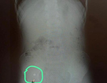 В Уфе 7-летний мальчик проглотил магнитные шарики: врачи провели срочную операцию