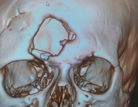 С «дырой во лбу». В Башкирии врачи установили 18-летней пациентке титановую пластину в череп
