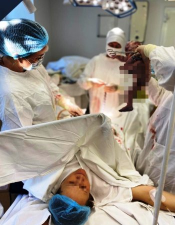 В Уфе врачи удалили у беременной пациентки гигантскую миому