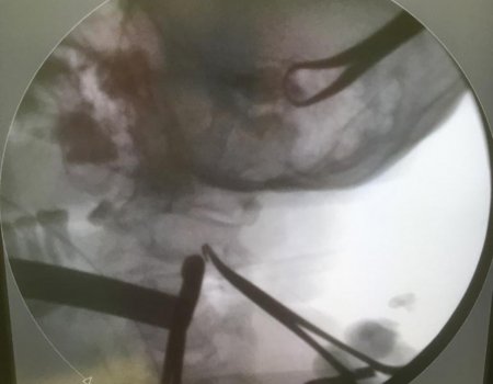 Уфимские хирурги прооперировали участника СВО, удалив осколок гранаты из сонной артерии