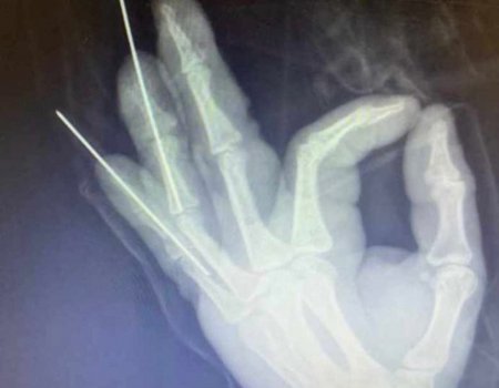 Веер из спиц: в Башкортостане врачи помогли мужчине со сломанными пальцами на руке